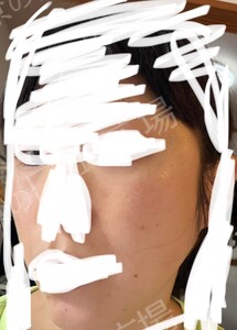 治療前の症例写真