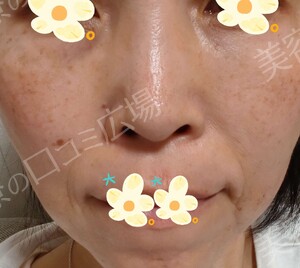 治療直後の症例写真