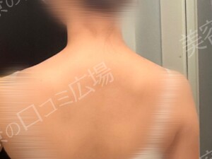 治療直後の症例写真