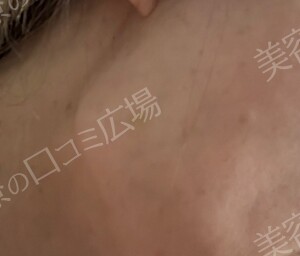 治療直後の症例写真