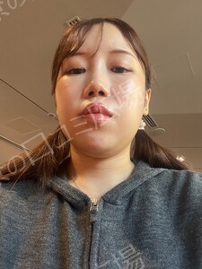 ボトックス韓国製200単位｜エラ・肩・ワキ・ふくらはぎからの治療直後の症例写真