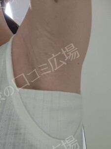 ミラドライ 両わき 1回 レベル８＋部分重複照射の治療前の症例写真