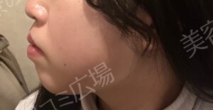 治療直後の症例写真