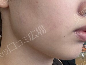 治療直後の症例写真