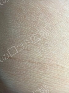 治療直後の症例写真