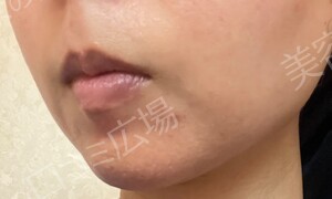 治療直後の症例写真