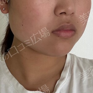 治療直後の症例写真