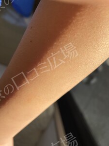 治療直後の症例写真