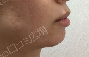 エラボトックス｜咬筋の張りとフェイスラインの治療結果の症例写真