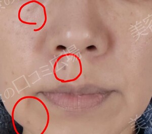 治療直後の症例写真