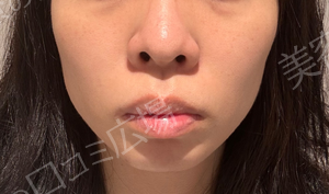 【初回限定】ピコトーニング＋ピコフラクショナル（全顔）の治療前の症例写真