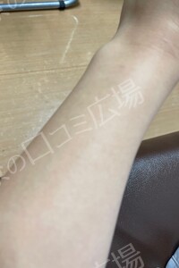 治療直後の症例写真