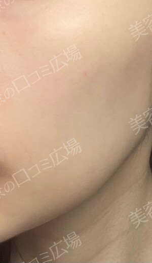 新宿ラクル美容外科クリニックのシミ取り・肝斑・毛穴治療の症例写真[ビフォー]