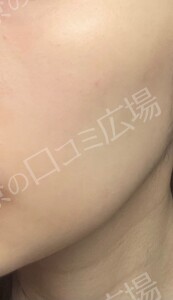 フォトフェイシャルStellar M22の治療前の症例写真