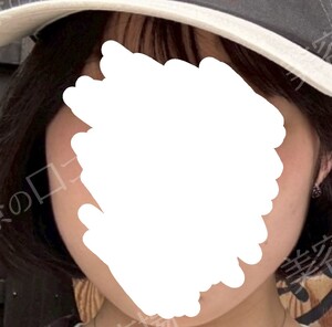 治療直後の症例写真