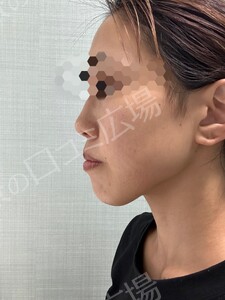 治療直後の症例写真
