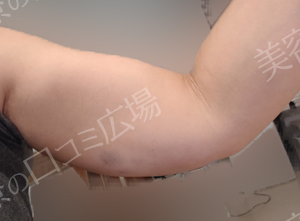 脂肪溶解注射｜エクリリス10ccの治療直後の症例写真