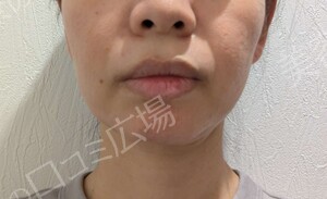 ボルニューマ｜フェイスラインのたるみの治療結果の症例写真