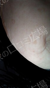 治療直後の症例写真