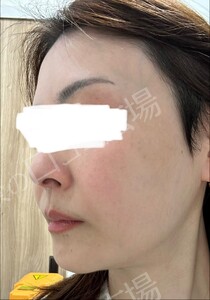治療直後の症例写真