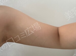 治療直後の症例写真