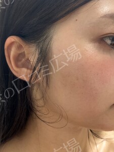 ジェネシスの治療前の症例写真