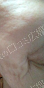 治療直後の症例写真