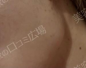 治療直後の症例写真