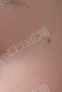 治療直後の症例写真
