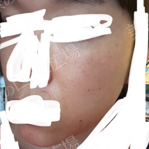 治療直後の症例写真