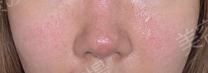 医療法人秀晄会 心斎橋コムロ美容外科クリニックの鼻の症例写真[ビフォー]