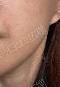 治療直後の症例写真