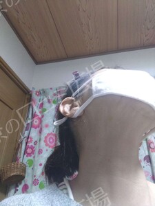 治療直後の症例写真