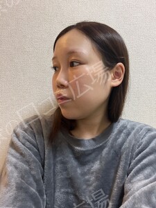 【筒井院長】脱脂術＋ピュアグラフティング　リポキューブの治療結果の症例写真