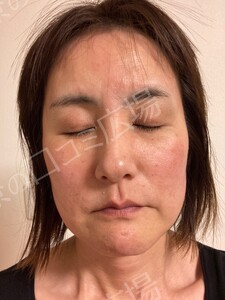 治療直後の症例写真