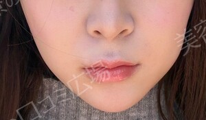 治療直後の症例写真