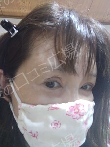 治療直後の症例写真