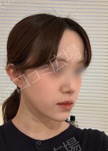 貴族手術（鼻翼基部プロテーゼ）｜ほうれい線を改善の治療前の症例写真