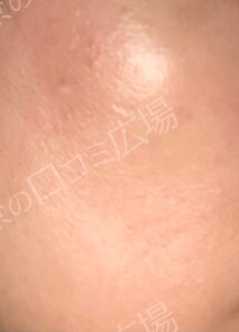 治療直後の症例写真