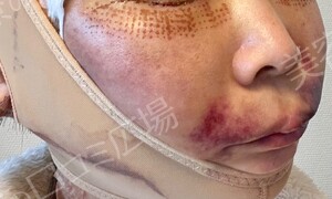 治療直後の症例写真