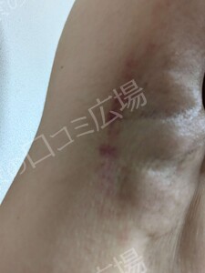 治療直後の症例写真
