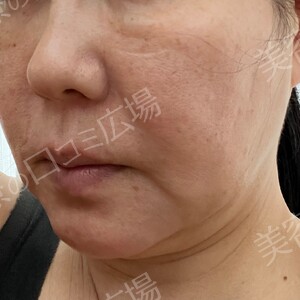 治療直後の症例写真