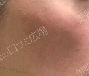 さっぽろ美容クリニック 本院のシミ・肝斑の症例写真[ビフォー]