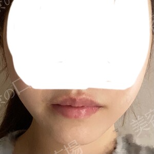 治療直後の症例写真