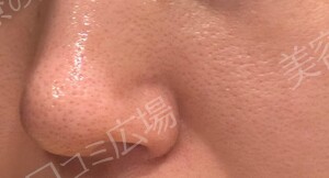 ハイドラジェントル｜毛穴の黒ずみを集中的に除去の治療前の症例写真