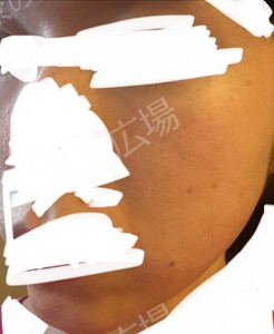 治療前の症例写真