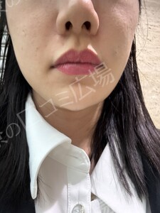 治療直後の症例写真
