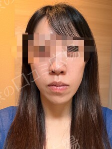 治療直後の症例写真