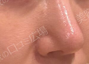 ハイドラジェントル｜毛穴の黒ずみを集中的に除去の治療結果の症例写真