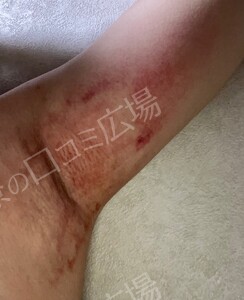 治療直後の症例写真